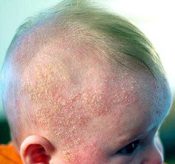 Jak vypadá pichlavé teplo u novorozenců na hlavě, foto