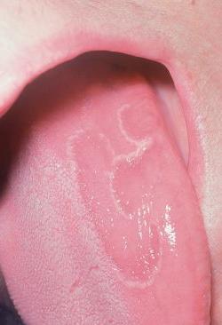 Rjava patina na jeziku