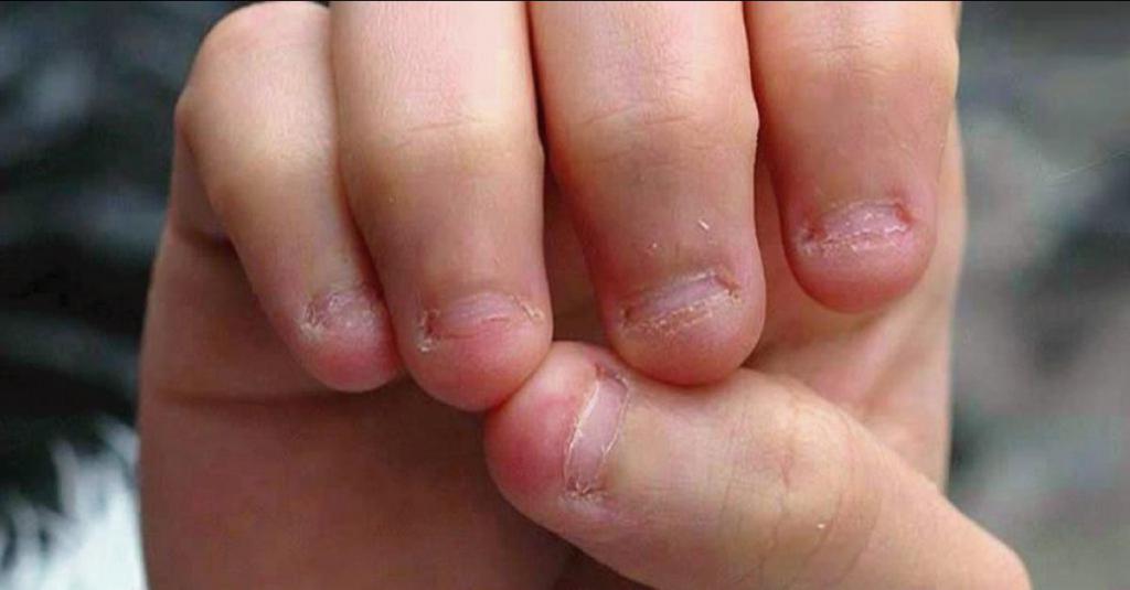 Sen pęknięty paznokci