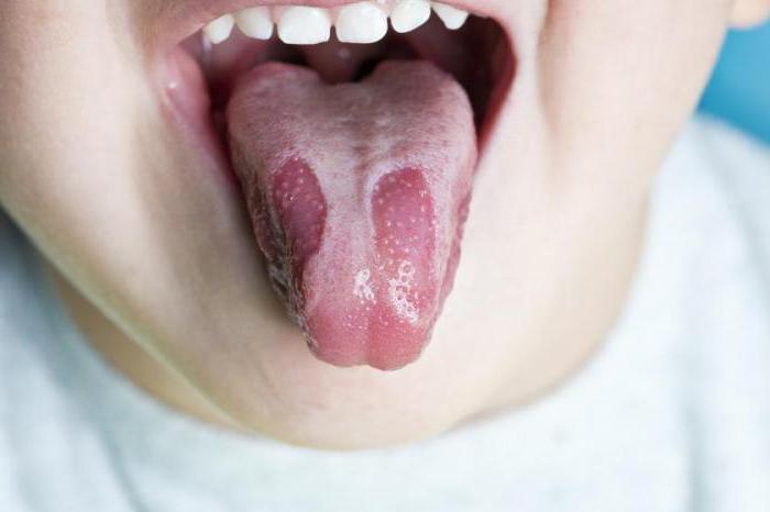 Što učiniti ako spalite jezik