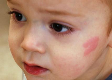 červené skvrny na tváři dítěte