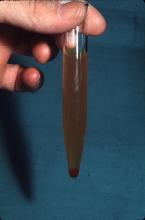 krvni strdki v urinu