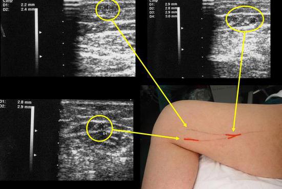дуплексно сканиране на вените на долните крайници