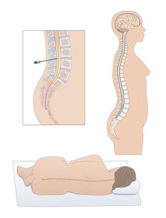 effetti di puntura del midollo spinale