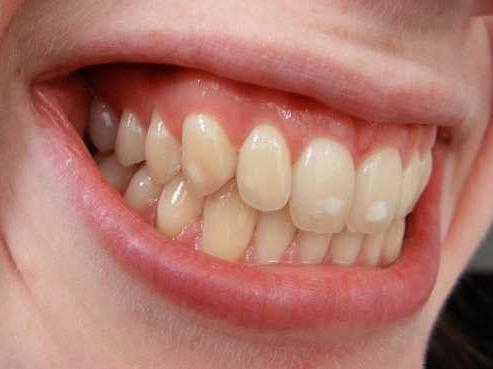 zubní granulom