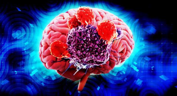 stadij možganskega tumorja