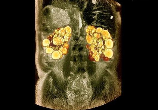 MRI abdominálních orgánů
