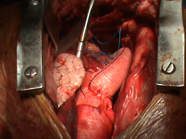Induracija aorte