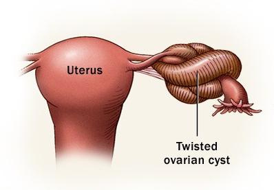 sintomi della cisti ovarica di cosa si tratta