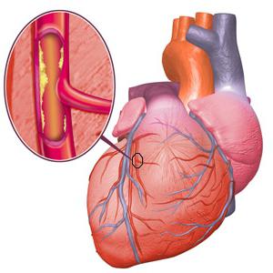 Co je angina pectoris?