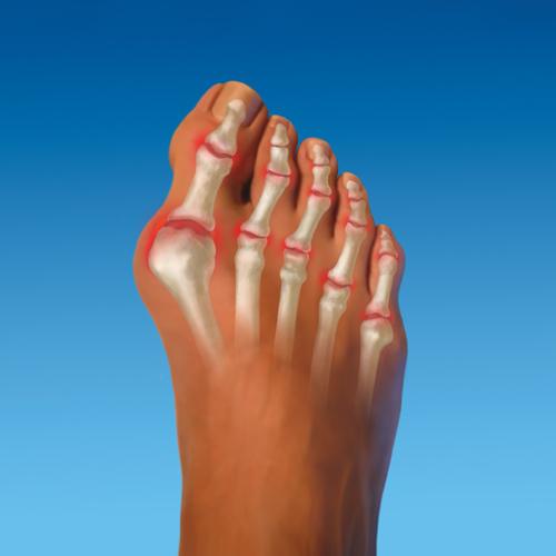 kako liječiti simptome artroze stopala i liječenje