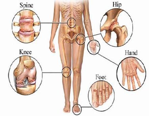 Deformirajuća artroza 1. stupnja zgloba gležnja - Išijas 