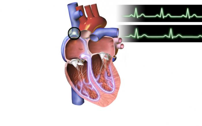 Co je sinusová bradykardie srdce