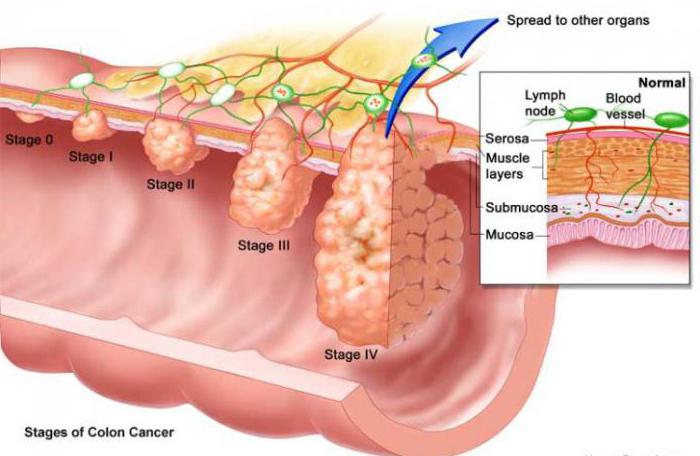 rakovina tlustého střeva