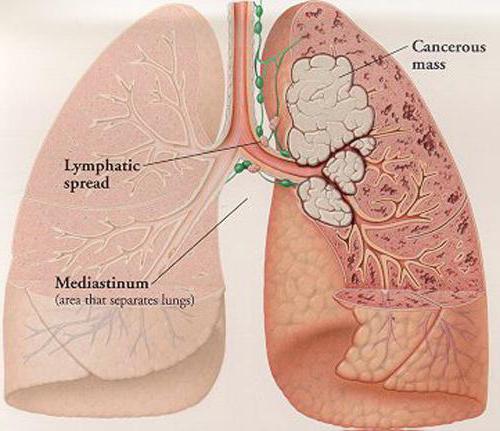 rakovina plic