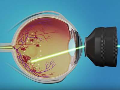 ласерска коагулација ретине