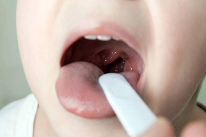 tonsillite e differenza di tonsillite