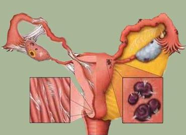 symptomy endometriózy