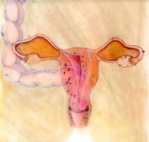 endometrióza a koncepce