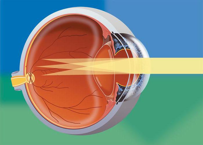 cos'è l'astigmatismo oculare