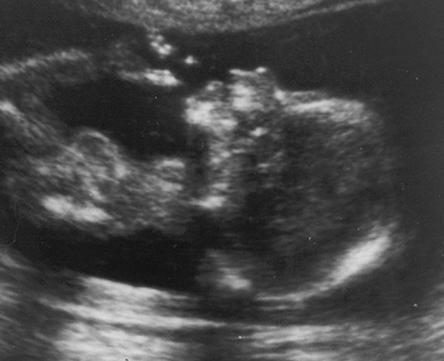 ipossia fetale durante il trattamento in gravidanza