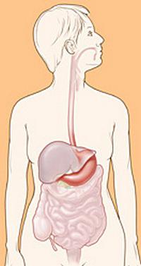 adenocarcinoma scarsamente differenziato dello stomaco
