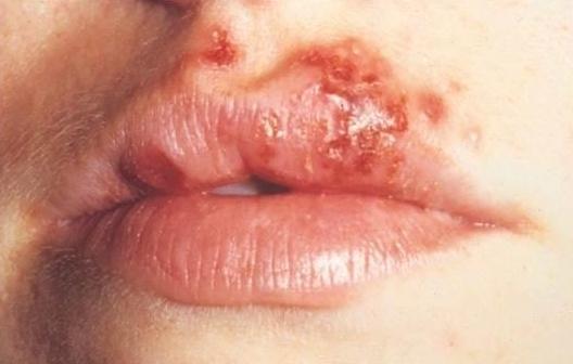 come sbarazzarsi di herpes sulle labbra