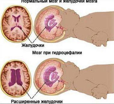 trattamento dell'idrocefalo cerebrale