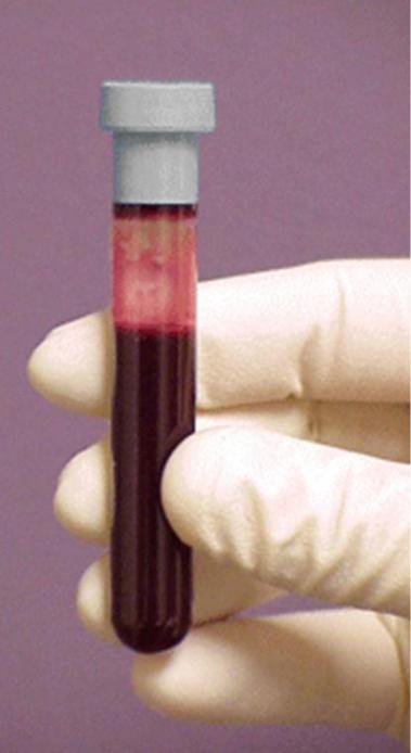 Kaj je biokemični krvni test