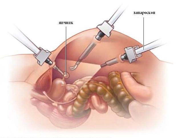 što je laparoskopija u ginekologiji