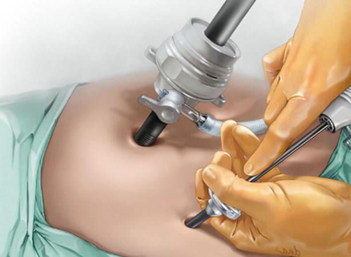 komplikacije nakon laparoskopije u ginekologiji
