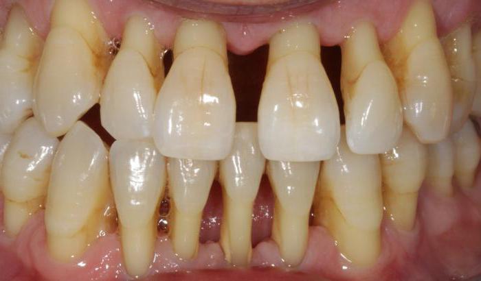 co je periodontální onemocnění