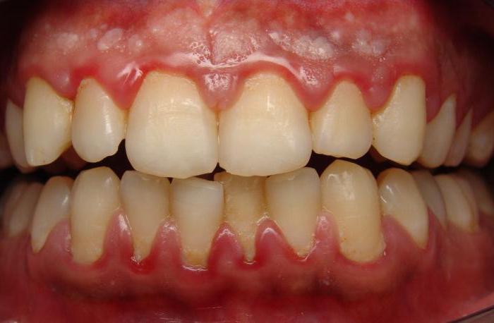 znakovi parodontne bolesti