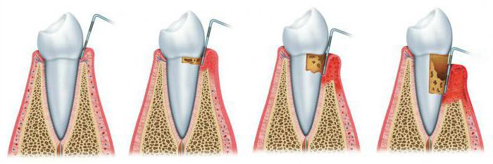 periodontalni stadij