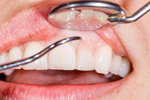 jak léčit periodontální dásně