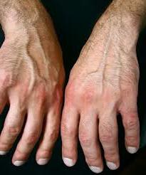 vzroki reaktivnega artritisa
