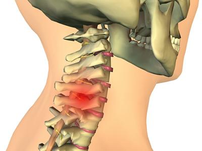 hernijo zdravljenja vratne hrbtenice