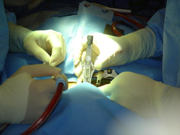 lasersko uklanjanje hernije vratne kralježnice