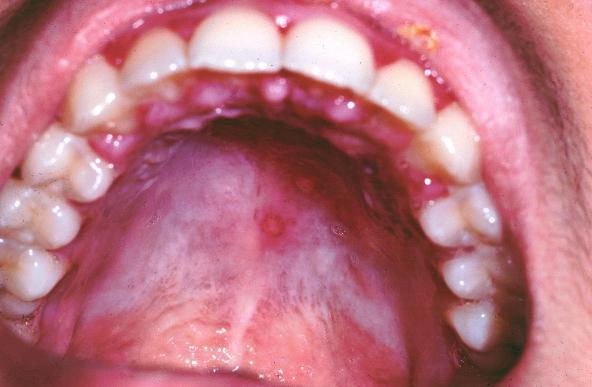 Co to jest leczenie zapalenia jamy ustnej?