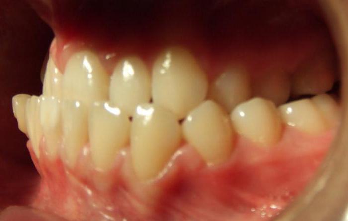врсте угриза у стоматологији код деце