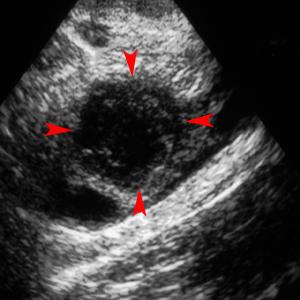 žluté tělo ve vaječníku během těhotenství