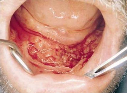 come si presenta il cancro alla gola