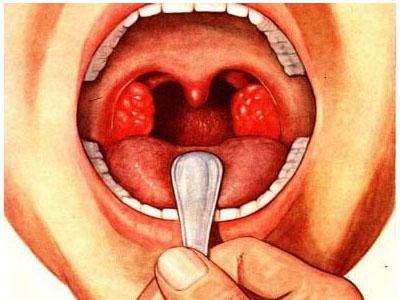 come curare la tonsillite