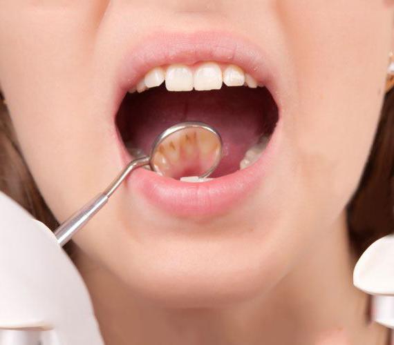 trattamento della carie dentale