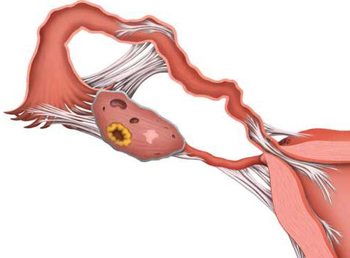 retroflekcija uterusa