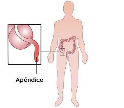 symptomy apendicitidy, které bolesti
