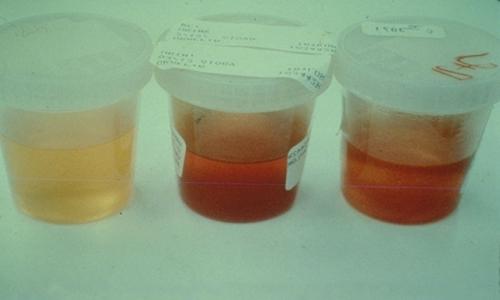 crvenih krvnih stanica u urinu
