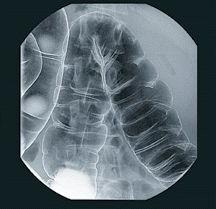 Črevesna rentgenska slika
