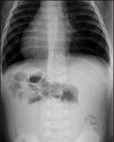 Radiografia intestinale