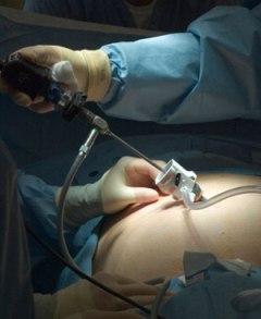 dolore dopo laparoscopia